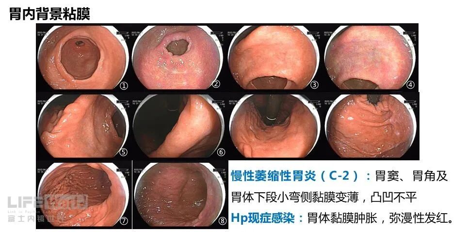 富士胃镜英文怎么写病例分享 ｜ 周环：一例不易判断的胃体病变的诊治分享（富士内镜早癌读片会）_https://www.jmylbn.com_新闻资讯_第3张