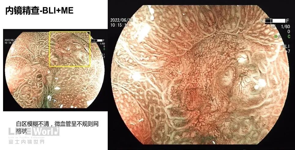 富士胃镜英文怎么写病例分享 ｜ 周环：一例不易判断的胃体病变的诊治分享（富士内镜早癌读片会）_https://www.jmylbn.com_新闻资讯_第21张