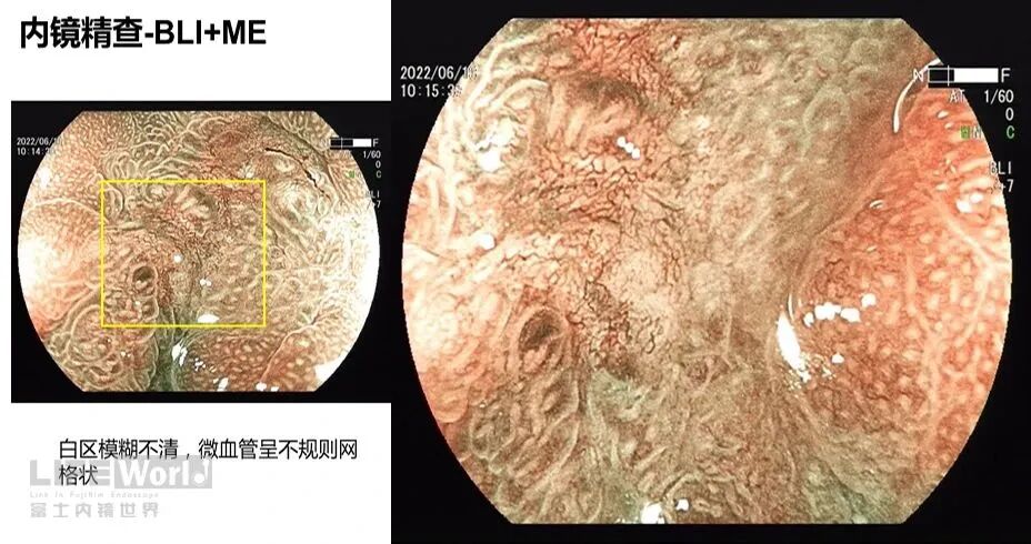 富士胃镜英文怎么写病例分享 ｜ 周环：一例不易判断的胃体病变的诊治分享（富士内镜早癌读片会）_https://www.jmylbn.com_新闻资讯_第20张