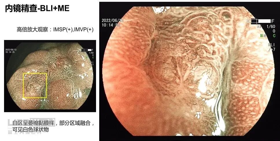 富士胃镜英文怎么写病例分享 ｜ 周环：一例不易判断的胃体病变的诊治分享（富士内镜早癌读片会）_https://www.jmylbn.com_新闻资讯_第18张