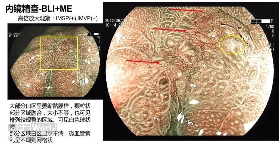 富士胃镜英文怎么写病例分享 ｜ 周环：一例不易判断的胃体病变的诊治分享（富士内镜早癌读片会）_https://www.jmylbn.com_新闻资讯_第19张