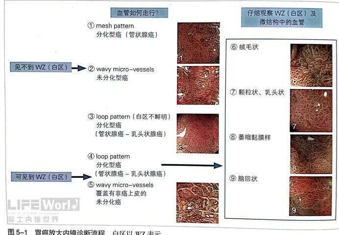 富士胃镜英文怎么写病例分享 ｜ 周环：一例不易判断的胃体病变的诊治分享（富士内镜早癌读片会）_https://www.jmylbn.com_新闻资讯_第17张