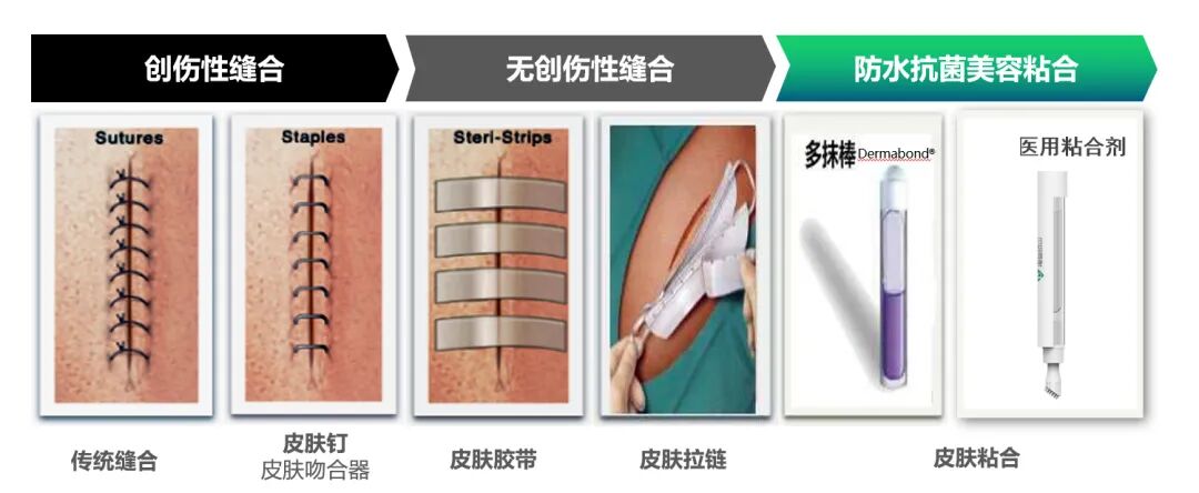 怎么买医用胶水科普｜你听说过医用胶水吗？_https://www.jmylbn.com_新闻资讯_第6张