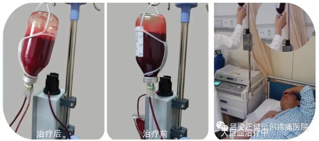 高压臭氧治疗什么高剂量高压臭氧自血疗法（HOT）——为什么对几乎所有疾病都有良好效果？_https://www.jmylbn.com_新闻资讯_第3张