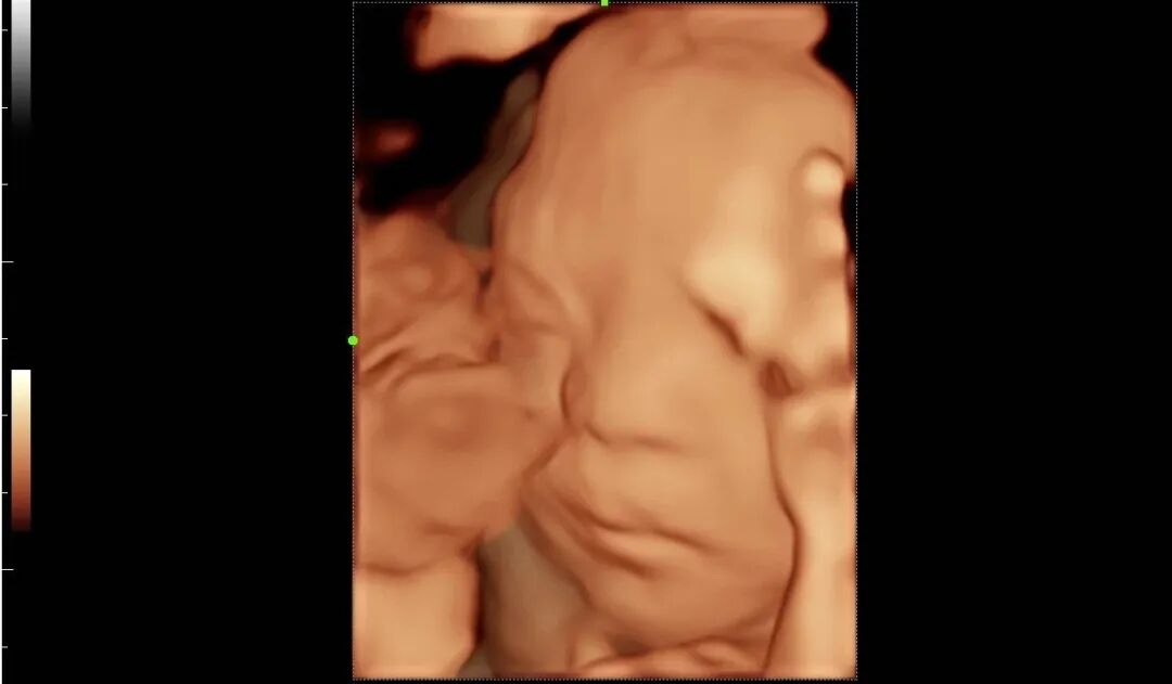 mindray超声怎么看参数【二轻医院喜报】mindray- Resonal9T高端彩色多普勒超声系统正式投入临床使用_https://www.jmylbn.com_新闻资讯_第8张