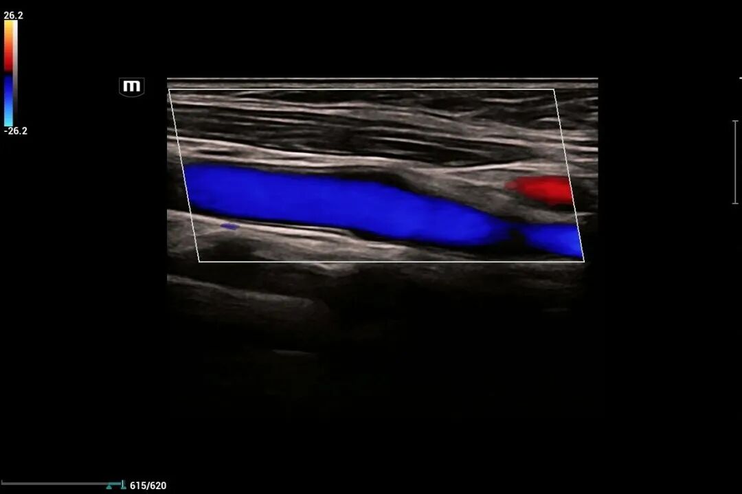 mindray超声怎么看参数【二轻医院喜报】mindray- Resonal9T高端彩色多普勒超声系统正式投入临床使用_https://www.jmylbn.com_新闻资讯_第6张