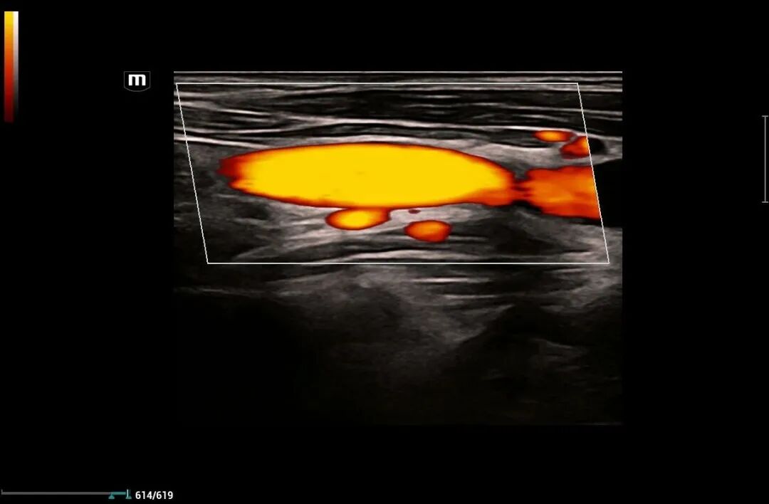 mindray超声怎么看参数【二轻医院喜报】mindray- Resonal9T高端彩色多普勒超声系统正式投入临床使用_https://www.jmylbn.com_新闻资讯_第5张
