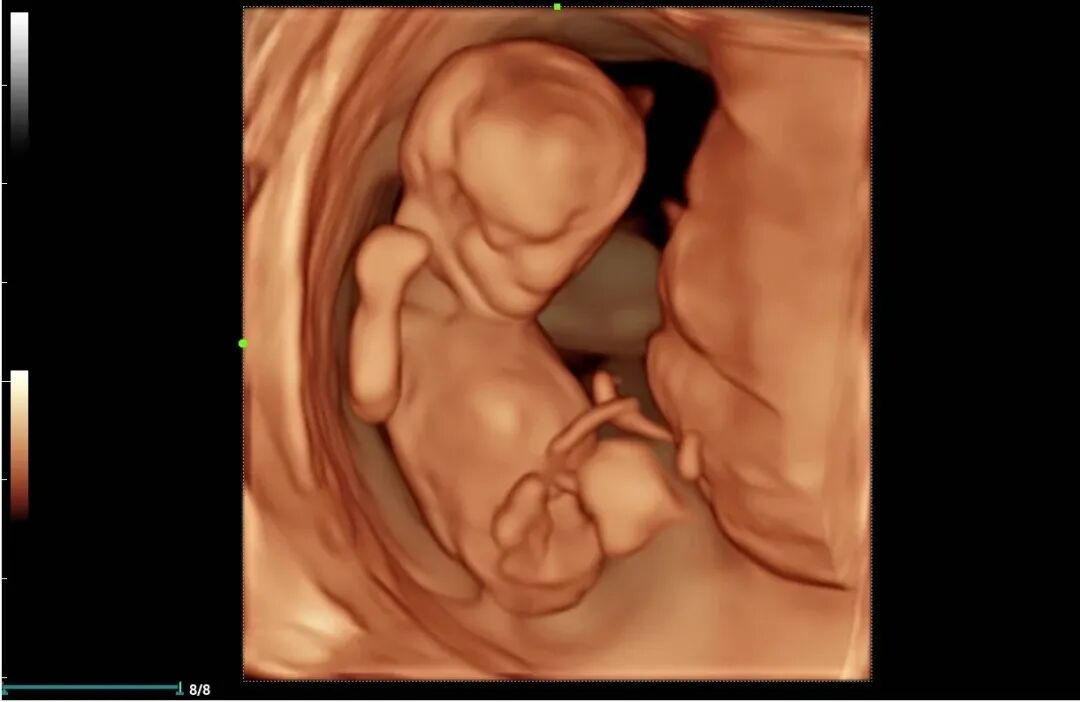 mindray超声怎么看参数【二轻医院喜报】mindray- Resonal9T高端彩色多普勒超声系统正式投入临床使用_https://www.jmylbn.com_新闻资讯_第10张