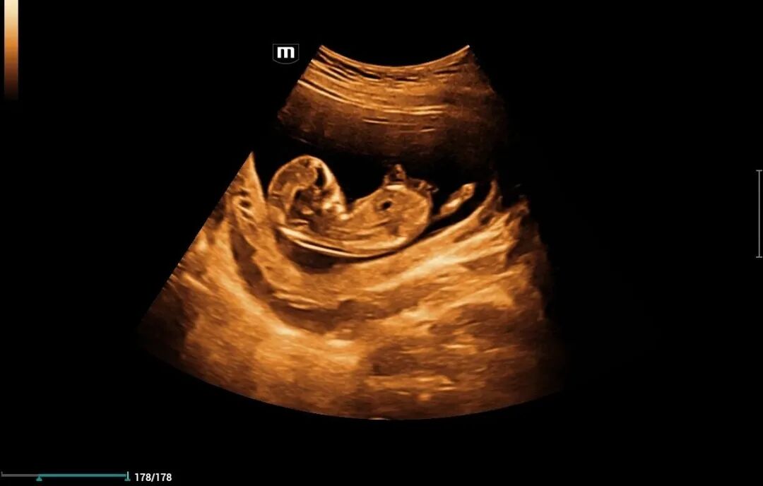 mindray超声怎么看参数【二轻医院喜报】mindray- Resonal9T高端彩色多普勒超声系统正式投入临床使用_https://www.jmylbn.com_新闻资讯_第9张