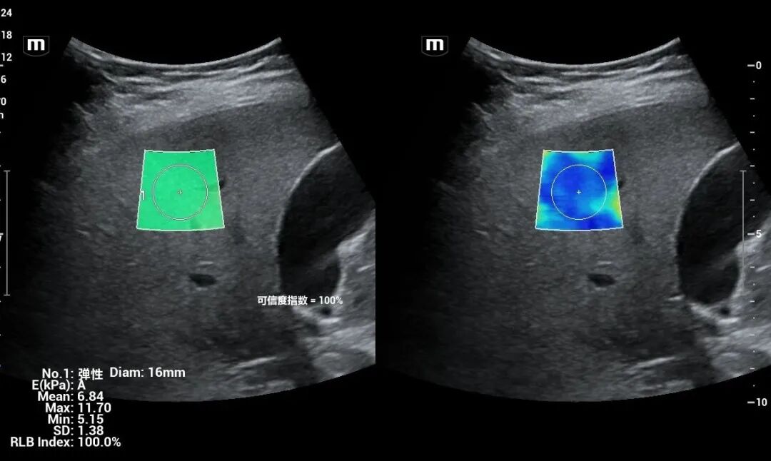 mindray超声怎么看参数【二轻医院喜报】mindray- Resonal9T高端彩色多普勒超声系统正式投入临床使用_https://www.jmylbn.com_新闻资讯_第3张