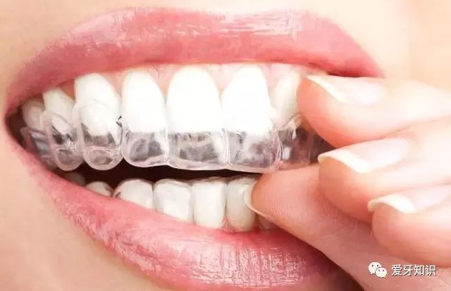 成都牙科医生任欢讲，牙齿矫正如何选择适合自己的牙套？