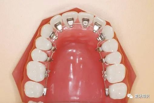成都牙科医生任欢讲，牙齿矫正如何选择适合自己的牙套？