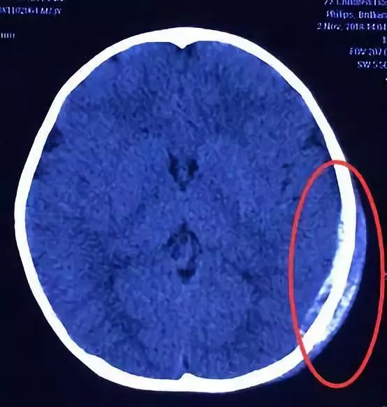 看護人必看！3歲寶寶摔成顱內出血！商場這幾個危險地方，一定別讓孩子單獨靠近 親子 第3張