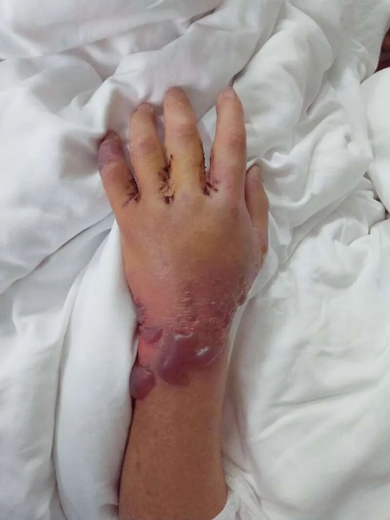 一条罗非鱼引发的死亡最终不幸离世……严重的海洋创伤弧菌感染没想到