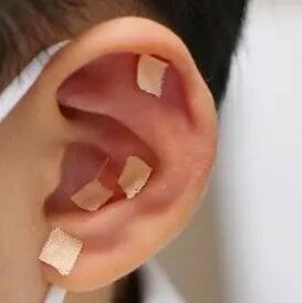 中医耳穴压豆可以预防近视？答案是……