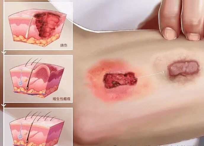 医用消疤贴怎么用【科普】疤痕增生疙瘩怎么才能消除？_https://www.jmylbn.com_新闻资讯_第7张