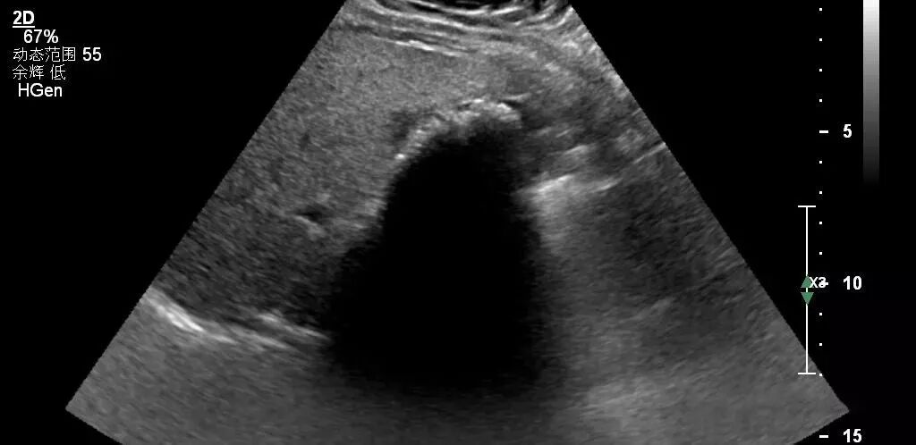 彩超伪像是什么【微课堂】二维超声常见伪像是如何产生的？_https://www.jmylbn.com_新闻资讯_第3张