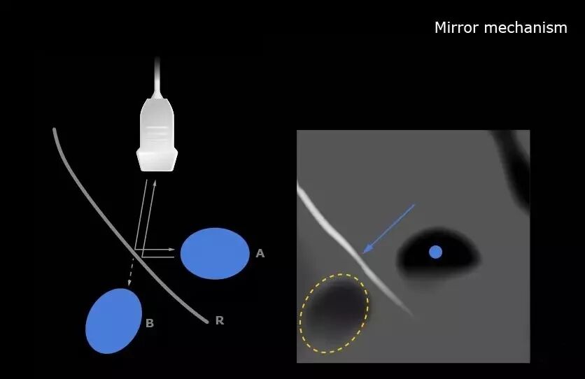 彩超伪像是什么【微课堂】二维超声常见伪像是如何产生的？_https://www.jmylbn.com_新闻资讯_第2张