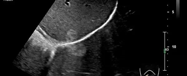 彩超伪像是什么【微课堂】二维超声常见伪像是如何产生的？_https://www.jmylbn.com_新闻资讯_第1张