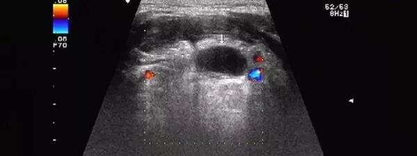 彩超伪像是什么【微课堂】二维超声常见伪像是如何产生的？_https://www.jmylbn.com_新闻资讯_第4张