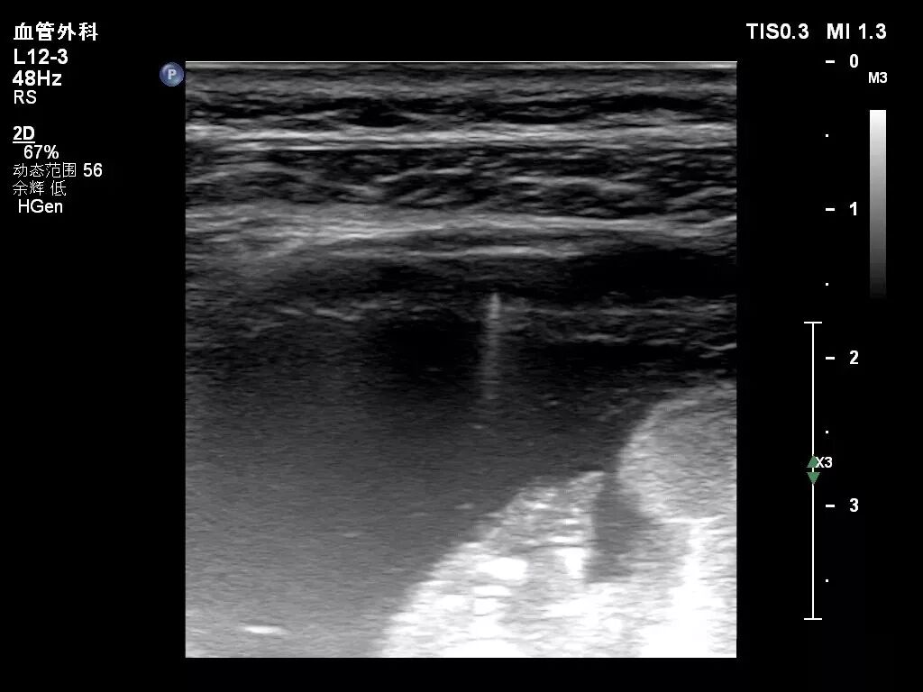 彩超伪像是什么【微课堂】二维超声常见伪像是如何产生的？_https://www.jmylbn.com_新闻资讯_第6张