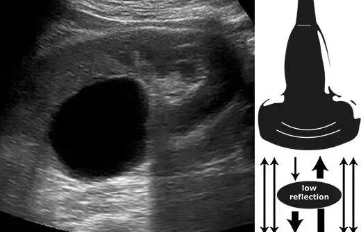 彩超伪像是什么【微课堂】二维超声常见伪像是如何产生的？_https://www.jmylbn.com_新闻资讯_第5张