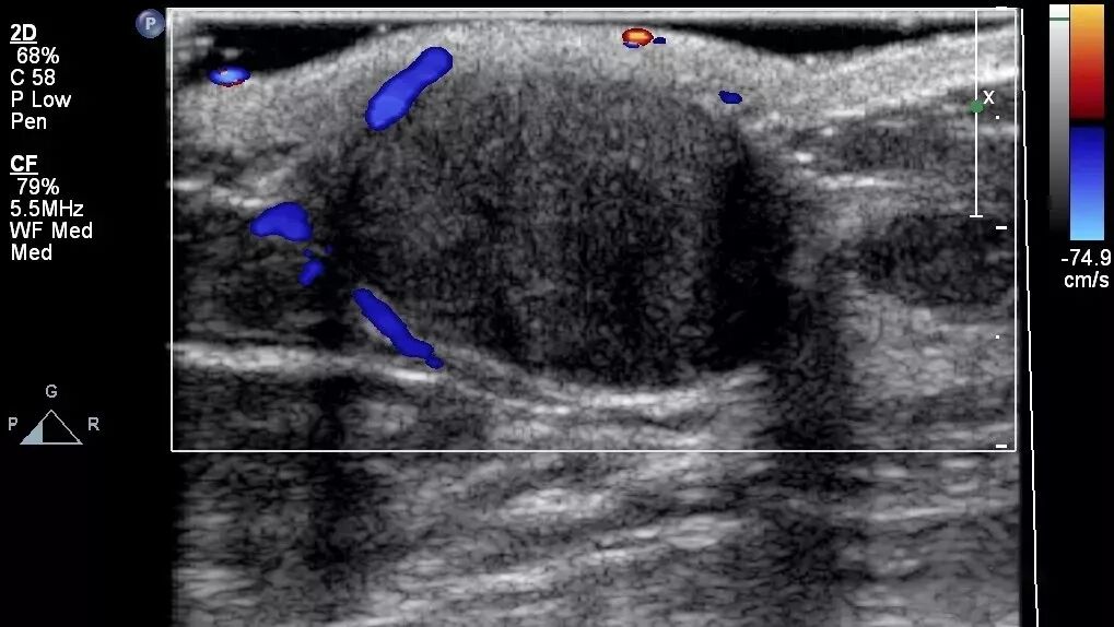 彩超伪像是什么【微课堂】二维超声常见伪像是如何产生的？_https://www.jmylbn.com_新闻资讯_第9张