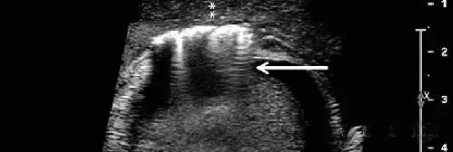 彩超伪像是什么【微课堂】二维超声常见伪像是如何产生的？_https://www.jmylbn.com_新闻资讯_第8张