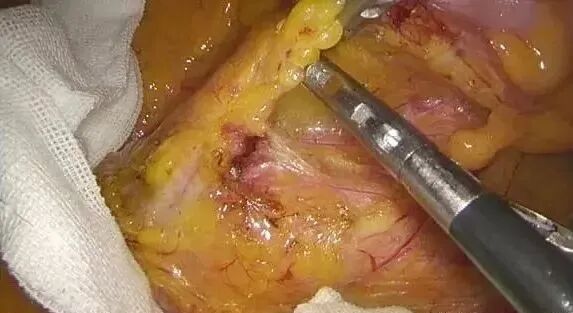 纱布片怎么使用方法腔镜手术中软纱布有什么用_https://www.jmylbn.com_新闻资讯_第7张