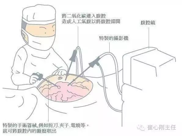 腹腔镜手术原理示意图图片