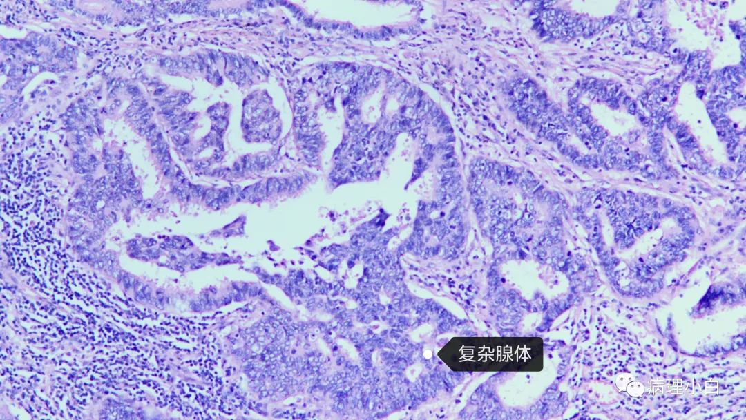 病理规培系列:肺浸润性腺癌