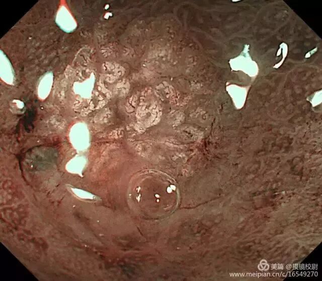 上皮细胞用什么染色内镜技术 ｜ 内镜黏膜染色剂的使用方法_https://www.jmylbn.com_新闻资讯_第21张