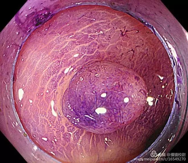 上皮细胞用什么染色内镜技术 ｜ 内镜黏膜染色剂的使用方法_https://www.jmylbn.com_新闻资讯_第3张