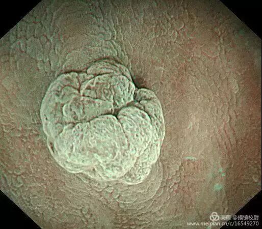 上皮细胞用什么染色内镜技术 ｜ 内镜黏膜染色剂的使用方法_https://www.jmylbn.com_新闻资讯_第17张