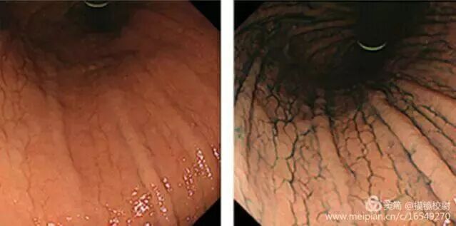 上皮细胞用什么染色内镜技术 ｜ 内镜黏膜染色剂的使用方法_https://www.jmylbn.com_新闻资讯_第14张