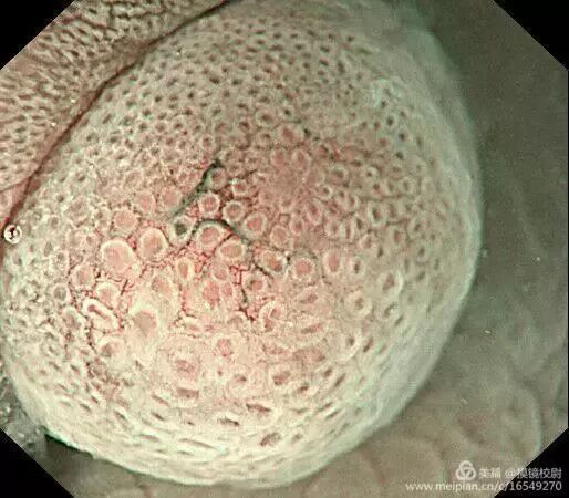 上皮细胞用什么染色内镜技术 ｜ 内镜黏膜染色剂的使用方法_https://www.jmylbn.com_新闻资讯_第18张