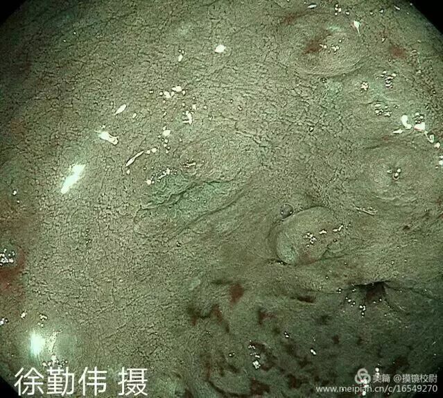 上皮细胞用什么染色内镜技术 ｜ 内镜黏膜染色剂的使用方法_https://www.jmylbn.com_新闻资讯_第11张