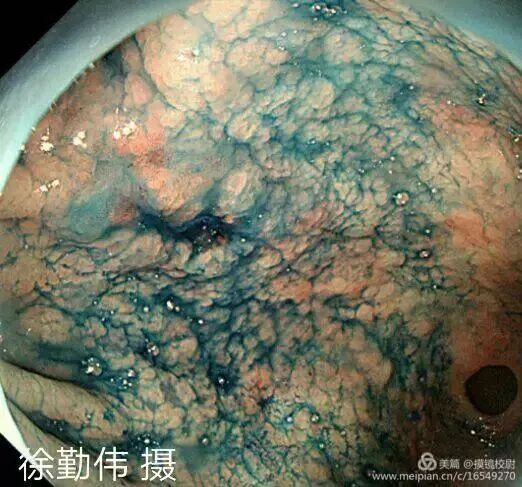 上皮细胞用什么染色内镜技术 ｜ 内镜黏膜染色剂的使用方法_https://www.jmylbn.com_新闻资讯_第9张