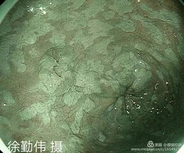 上皮细胞用什么染色内镜技术 ｜ 内镜黏膜染色剂的使用方法_https://www.jmylbn.com_新闻资讯_第12张