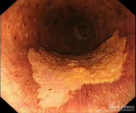 上皮细胞用什么染色内镜技术 ｜ 内镜黏膜染色剂的使用方法_https://www.jmylbn.com_新闻资讯_第6张