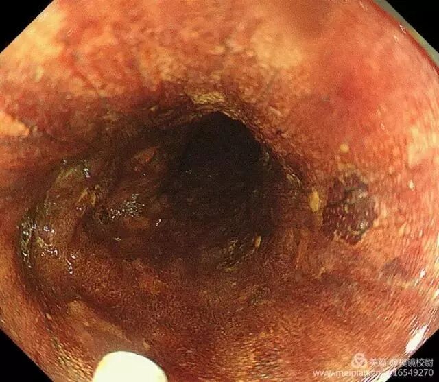 上皮细胞用什么染色内镜技术 ｜ 内镜黏膜染色剂的使用方法_https://www.jmylbn.com_新闻资讯_第5张