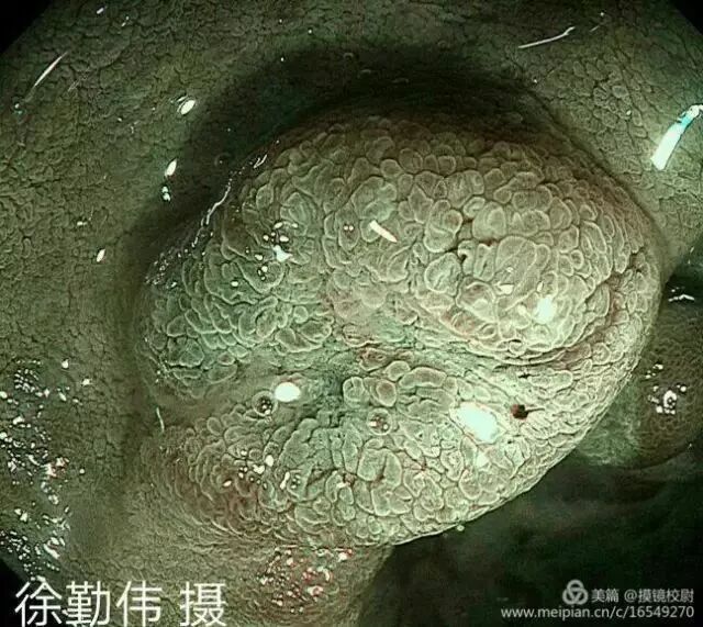 上皮细胞用什么染色内镜技术 ｜ 内镜黏膜染色剂的使用方法_https://www.jmylbn.com_新闻资讯_第13张