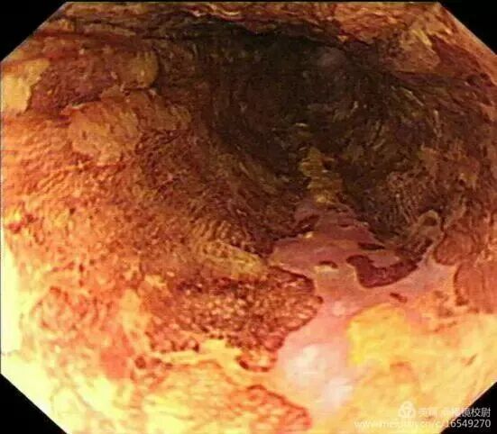 上皮细胞用什么染色内镜技术 ｜ 内镜黏膜染色剂的使用方法_https://www.jmylbn.com_新闻资讯_第7张