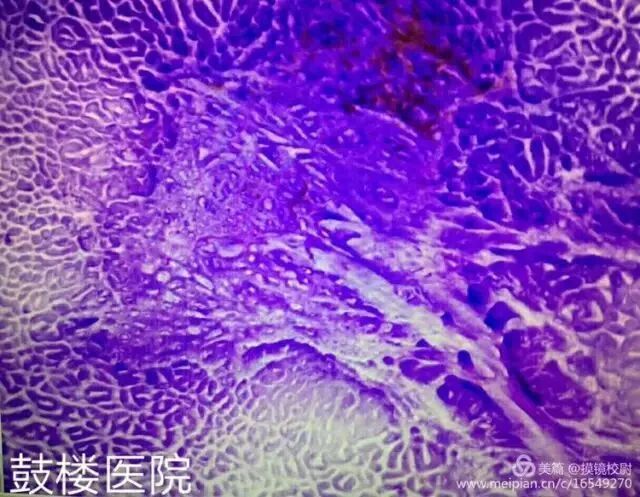 上皮细胞用什么染色内镜技术 ｜ 内镜黏膜染色剂的使用方法_https://www.jmylbn.com_新闻资讯_第15张