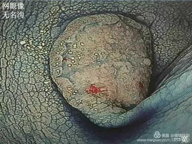 上皮细胞用什么染色内镜技术 ｜ 内镜黏膜染色剂的使用方法_https://www.jmylbn.com_新闻资讯_第16张