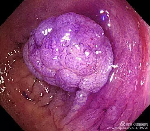 上皮细胞用什么染色内镜技术 ｜ 内镜黏膜染色剂的使用方法_https://www.jmylbn.com_新闻资讯_第2张