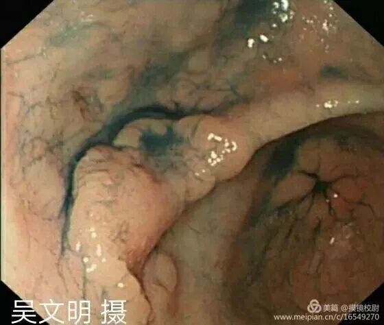 上皮细胞用什么染色内镜技术 ｜ 内镜黏膜染色剂的使用方法_https://www.jmylbn.com_新闻资讯_第10张