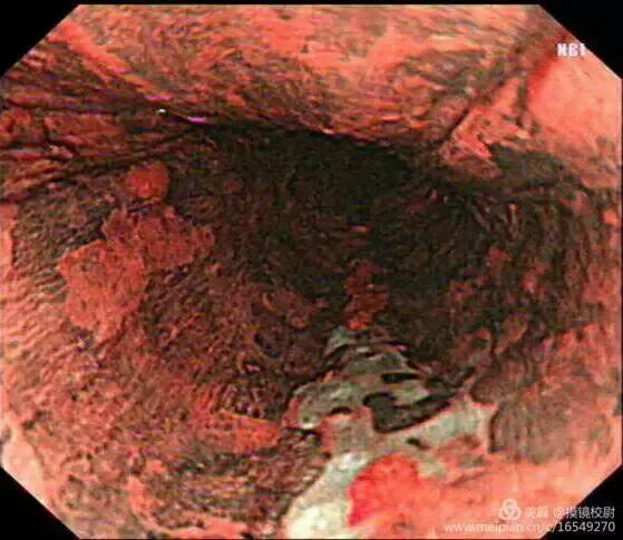 上皮细胞用什么染色内镜技术 ｜ 内镜黏膜染色剂的使用方法_https://www.jmylbn.com_新闻资讯_第8张