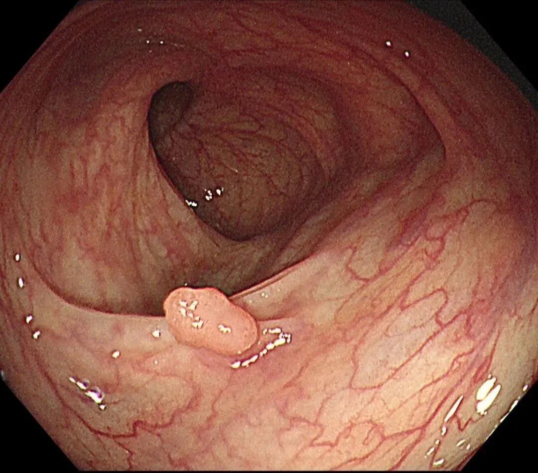 为什么说热活检钳小息肉切除术应放弃热活检钳吗？_https://www.jmylbn.com_新闻资讯_第4张