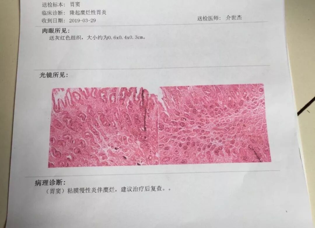 胃隆起型糜烂的原因和治疗